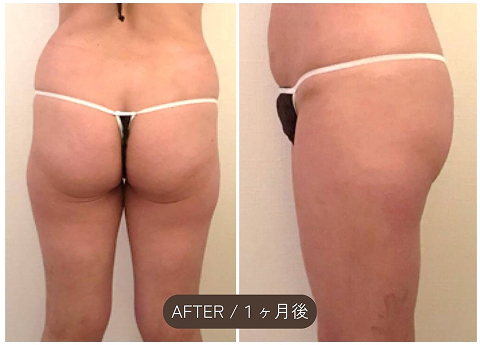 施術後（After）
