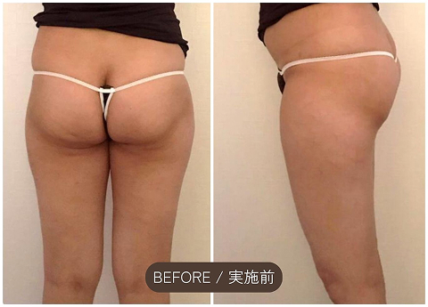 施術前（Before）