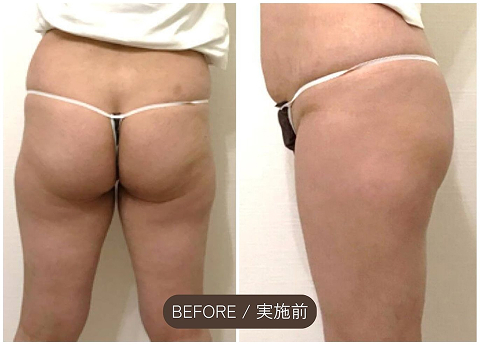 施術前（Before）