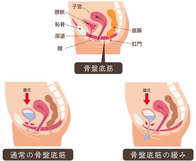 骨盤底筋が衰えるとどうなるか